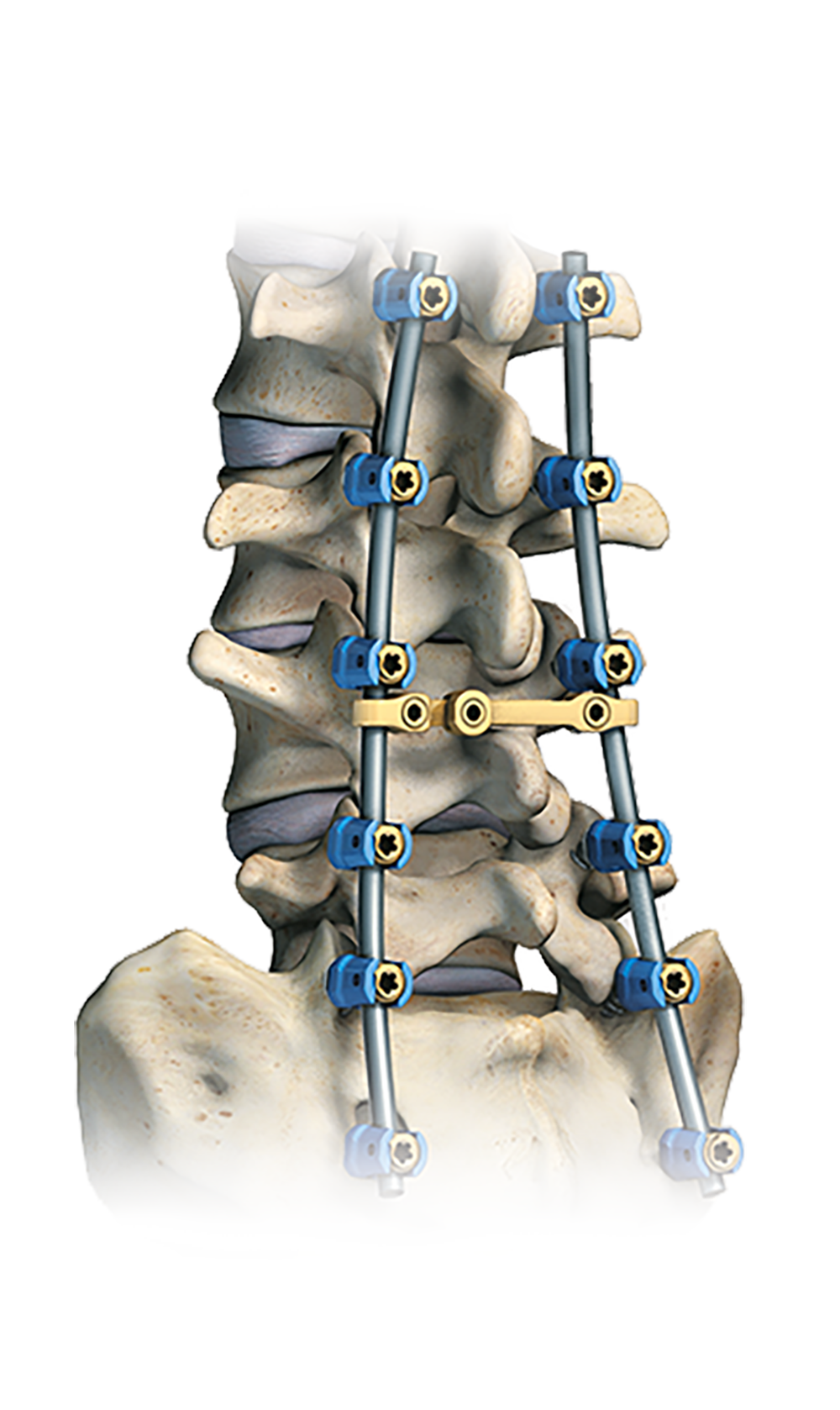 Polaris™ Spinal System