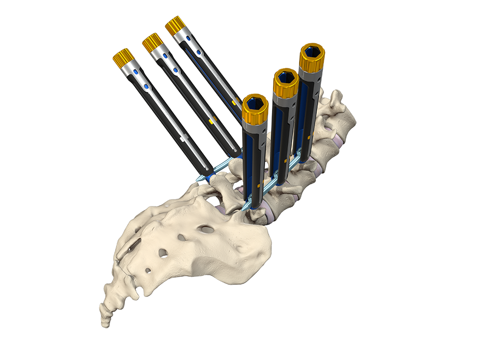 Vital™ MIS Spinal Fixation System